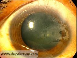 کدورت قرنیه (کراتوپاتی باند شکل) به دنبال التهاب طولانی مدت داخل چشمی